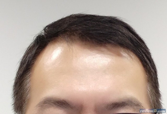 is 5mg of finasteride too much